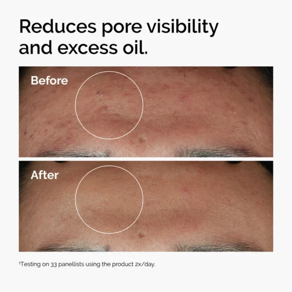 ord-niacinamide-zinc-blemish-serum-before-after-pores سرم نیاسینامید و زینک اوردینری